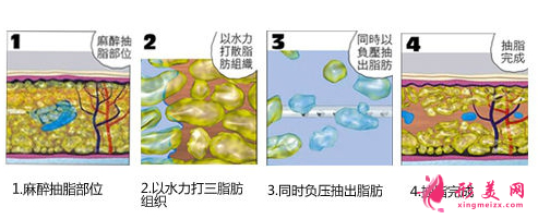 上臂吸脂一般什么价位