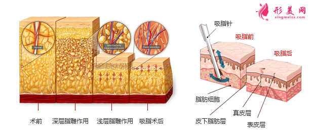 上臂吸脂一般什么价位