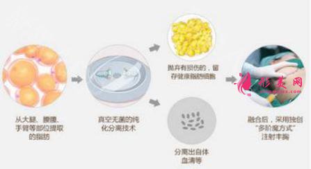 自身脂肪隆胸手术比假体好吗