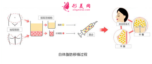 自身脂肪隆胸手术比假体好吗