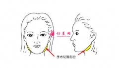 磨骨瘦脸手术多少钱？术后6大注意事项要谨记