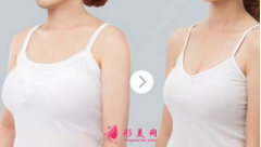 巨乳缩小术后多久能恢复？