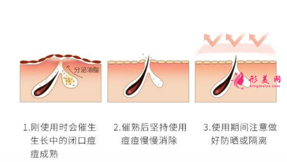 果酸换肤是什么