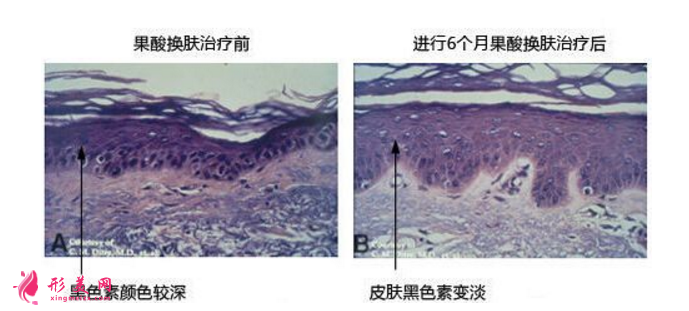 果酸换肤是什么