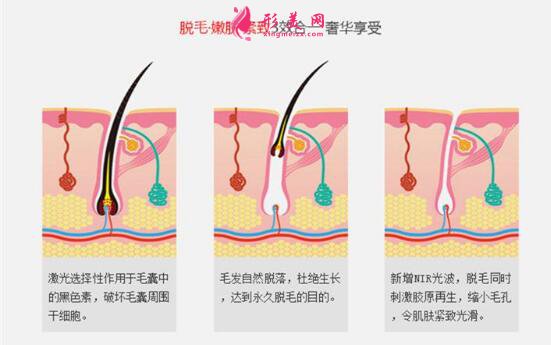 大腿永久脱毛多少钱