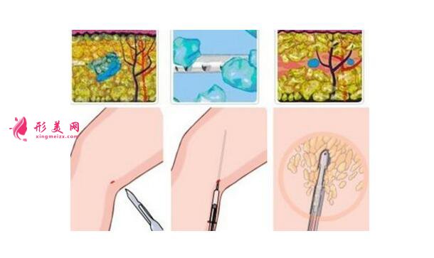小腿吸脂减肥效果
