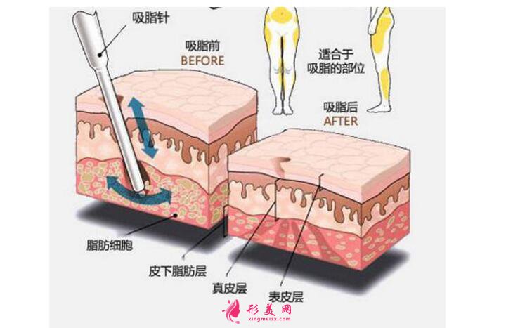 胳膊吸脂价格