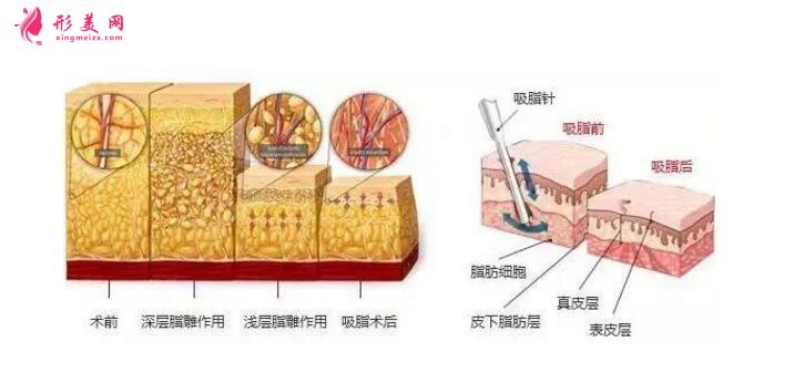 胳膊吸脂价格