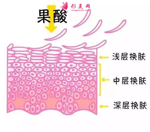 果酸换肤需要多少钱