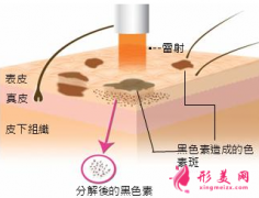 激光治疗黄褐斑每次要间隔多久