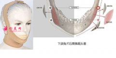 下颌角切除一般多少钱？术前术后注意事项预览！