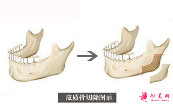 下颌角切除一般多少钱