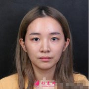 深圳美莱周洪超医生双眼皮案例术后效果反馈