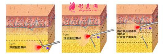 什么是激光溶脂瘦大腿?