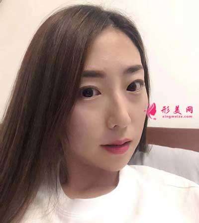 到和颜美帕找刘喆做的白瓷娃娃 术后15天效果很好