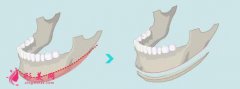 下颌角截骨量多少比较合适？多少有区别吗？