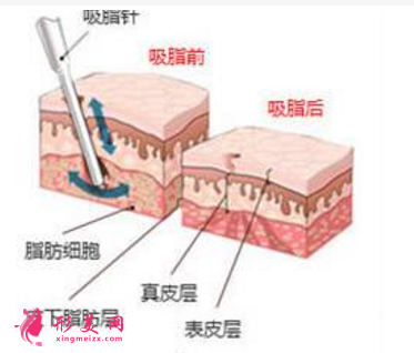 腿吸脂费用