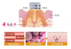 面部光子嫩肤能带来哪些效果？需要做多少钱次