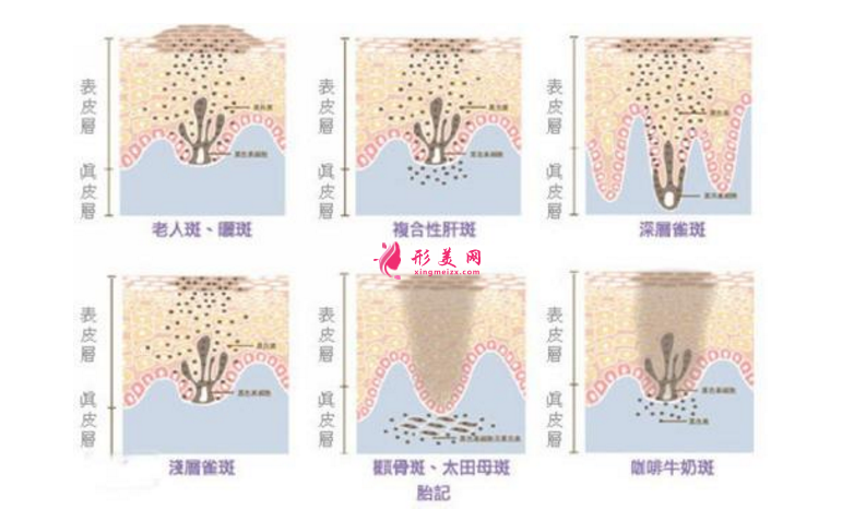 术前科普：激光祛斑多少钱一次？