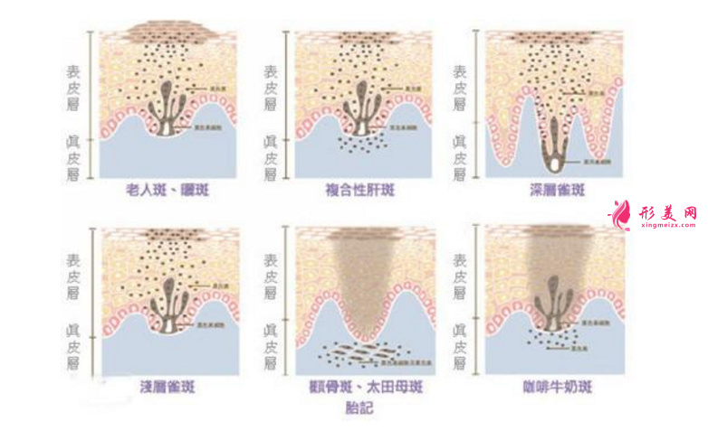 术前科普：激光祛斑多少钱一次？