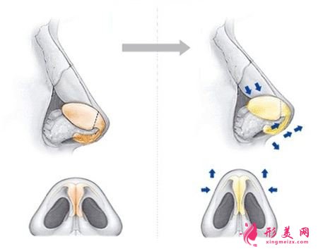 鼻翼整形的价格是多少？术后注意事项~