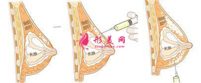 自体脂肪隆胸好吗？术前准备工作要知道！