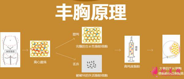 自体脂肪隆胸好吗？术前准备工作要知道！