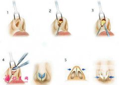 北京整形医院假体隆鼻价格及假体隆鼻的后遗症~