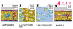 上臂吸脂切口在哪里？穿多久塑身衣？