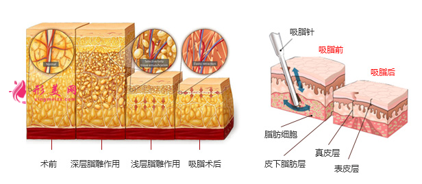 上臂吸脂一般什么价位