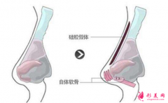 【术前科普】硅胶垫鼻梁多久要取出来？