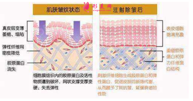 注射除皱效果怎么样？附术前术后注意事项！