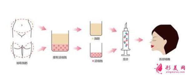 做自体脂肪隆鼻可能会变宽吗?危害什么