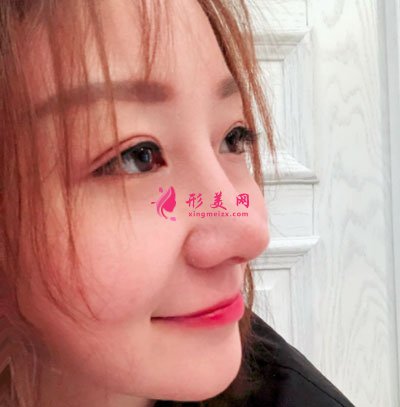 北京美莱医疗美容医院鼻部多项手术案例