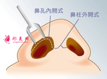 广州哪里做鼻翼缩小整形好