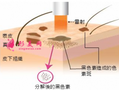 激光祛斑后多少天可以洗脸？