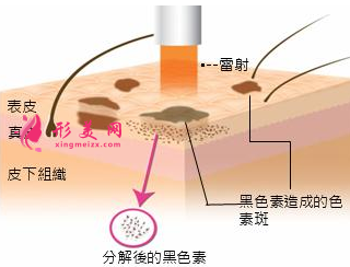 激光祛斑后多少天可以洗脸