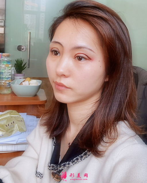 找成都美绽美整形美容医院陈宇做的眼综合，案例|价格分享给大家