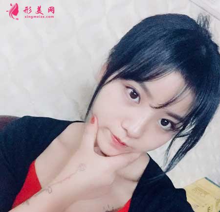 鼻综合整形术后15天