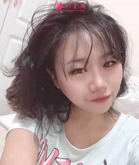 热拉提手术后