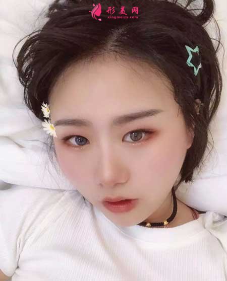 热拉提手术后40天