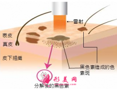 孕期可以做激光祛黄褐斑吗？