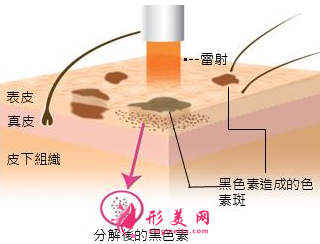 孕期可以做激光祛黄褐斑吗