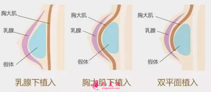 假体隆胸费用受什么因素影响