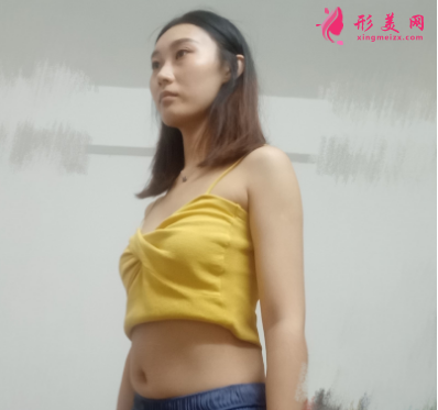 重庆美圣美邦整形医院任志伟腰腹吸脂