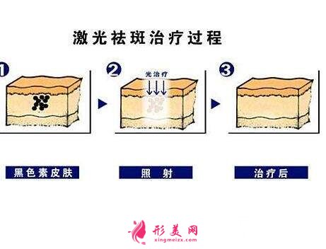 去除脸上黄褐斑