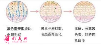 去除脸上黄褐斑有哪些方法？效果好吗？