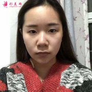 去成都华美紫馨找陈杨做全切双眼皮，术后70天恢复效果对比图