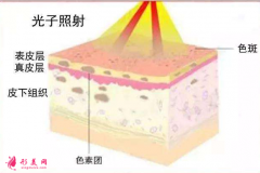 光子嫩肤需要做多少次？