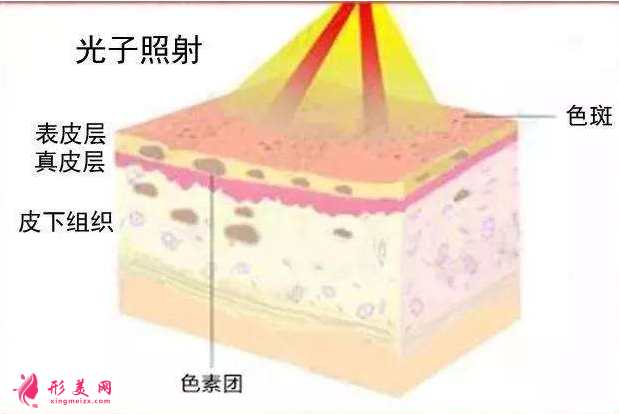 光子嫩肤需要做多少次